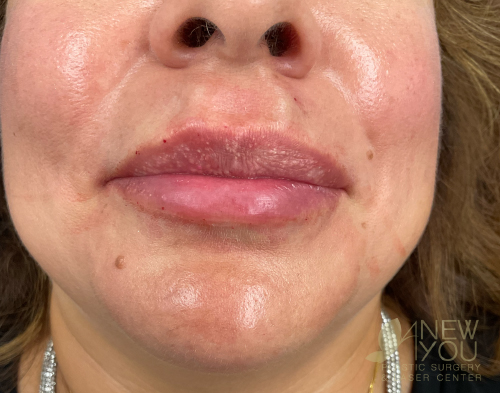 Lip Augmentation After - Chicago, IL