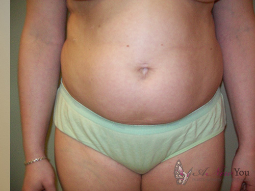 Liposuction Before - Chicago, IL