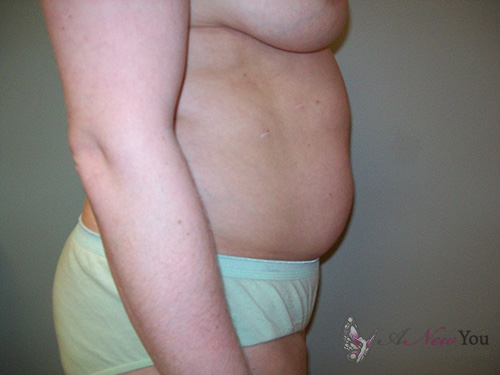 Liposuction Before - Chicago, IL