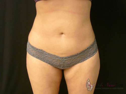 Liposuction After - Chicago, IL