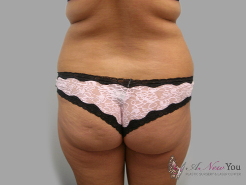 Liposuction Before - Chicago, IL