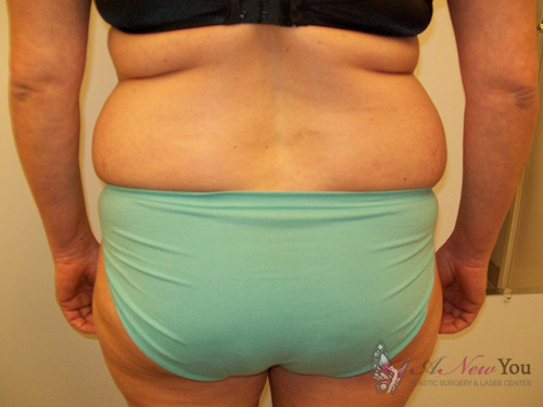 Liposuction Before - Chicago, IL