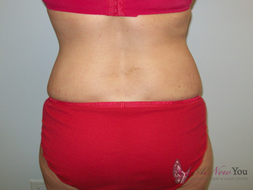 Liposuction After - Chicago, IL