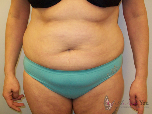 Liposuction Before - Chicago, IL