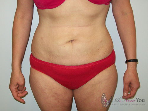 Liposuction After - Chicago, IL