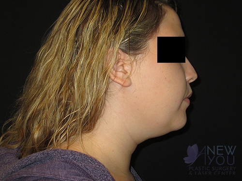 Liposuction Before - Chicago, IL