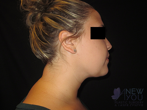 Liposuction After - Chicago, IL