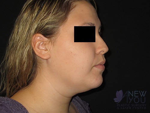 Liposuction Before - Chicago, IL