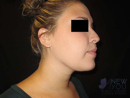 Liposuction After - Chicago, IL