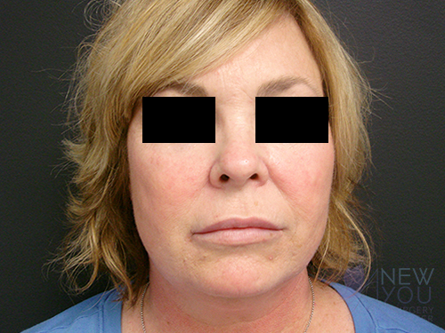 Liposuction Before - Chicago, IL