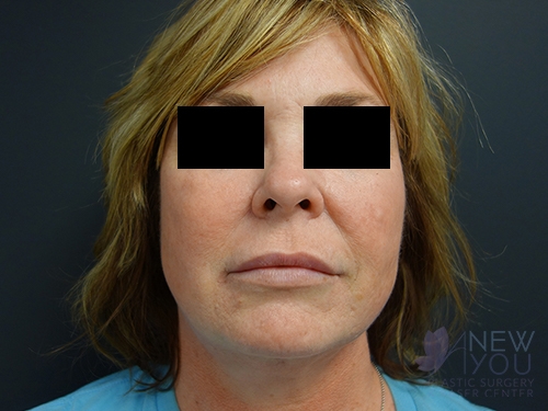 Liposuction After Liposuction After - Chicago, IL