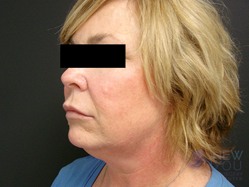 Liposuction Before Liposuction Before - Chicago, IL