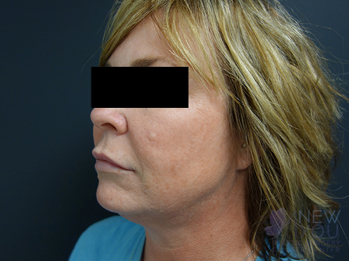 Liposuction After Liposuction After - Chicago, IL