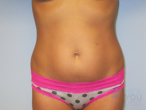 Liposuction Before - Chicago, IL