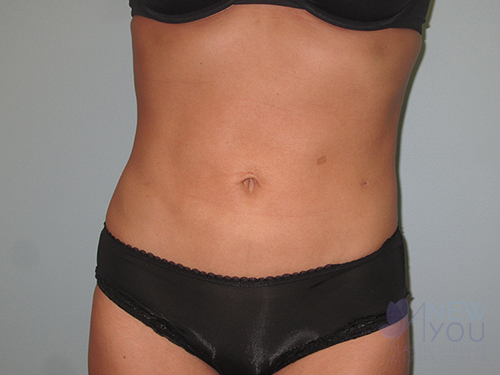 Liposuction After - Chicago, IL