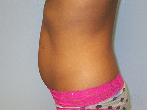 Liposuction Before - Chicago, IL