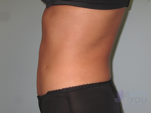 Liposuction After - Chicago, IL