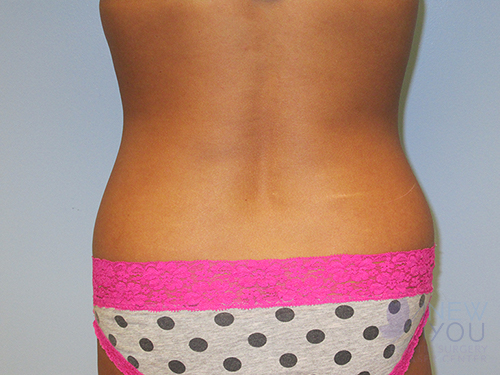 Liposuction Before - Chicago, IL