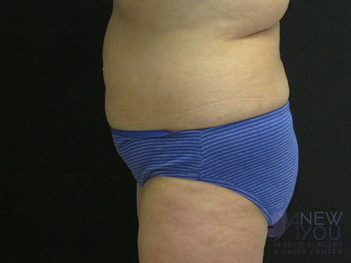 Liposuction Before - Chicago, IL