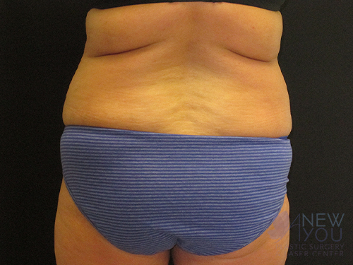 Liposuction Before - Chicago, IL