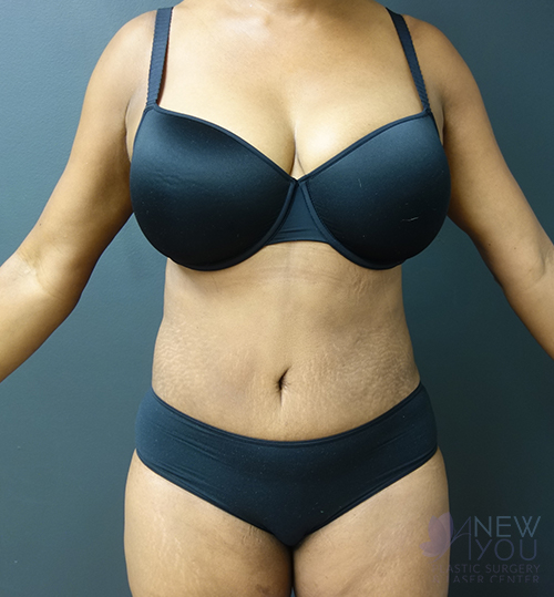 Liposuction After - Chicago, IL