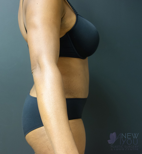 Liposuction After - Chicago, IL