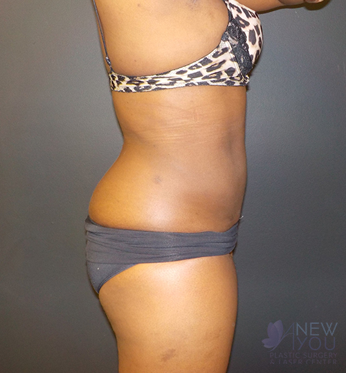 Liposuction After - Chicago, IL