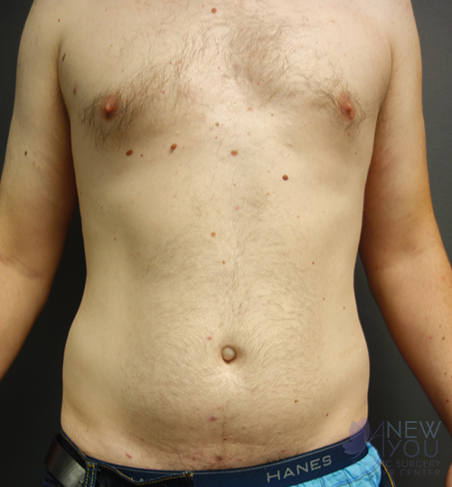 Liposuction Before - Chicago, IL