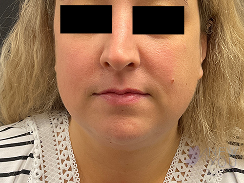 Liposuction Before Liposuction Before - Chicago, IL