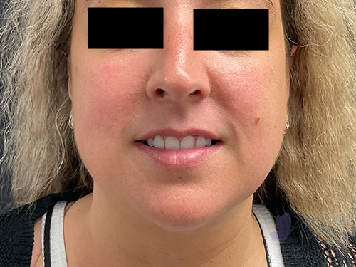 Liposuction After Liposuction After - Chicago, IL
