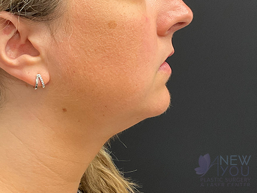 Liposuction After Liposuction After - Chicago, IL