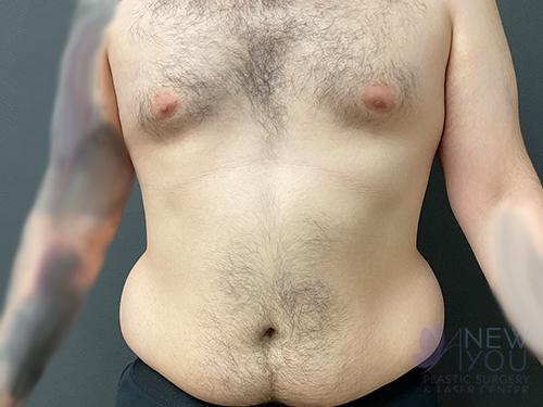 Liposuction Before - Chicago, IL