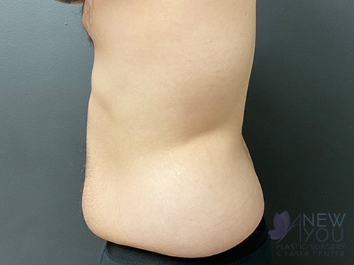 Liposuction Before - Chicago, IL