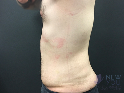 Liposuction After Liposuction After - Chicago, IL