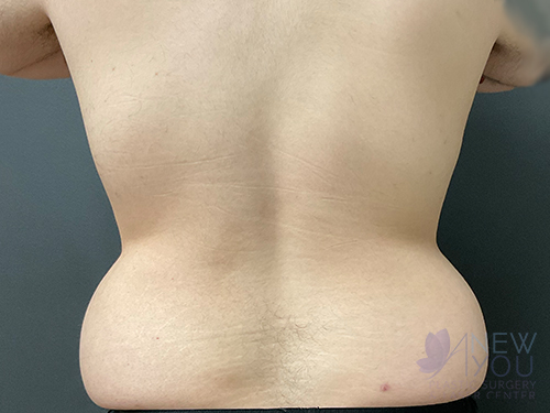 Liposuction Before - Chicago, IL