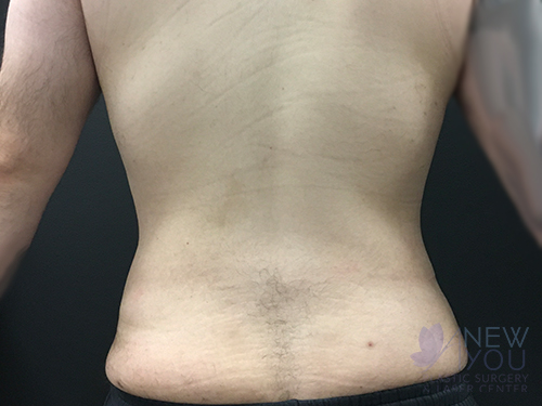 Liposuction After - Chicago, IL