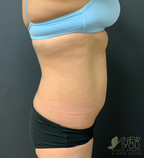 Liposuction Before - Chicago, IL