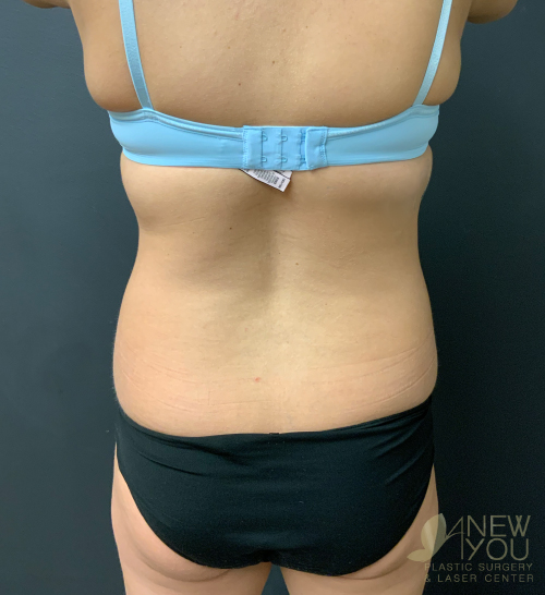 Liposuction Before - Chicago, IL
