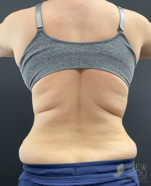 Liposuction Before - Chicago, IL