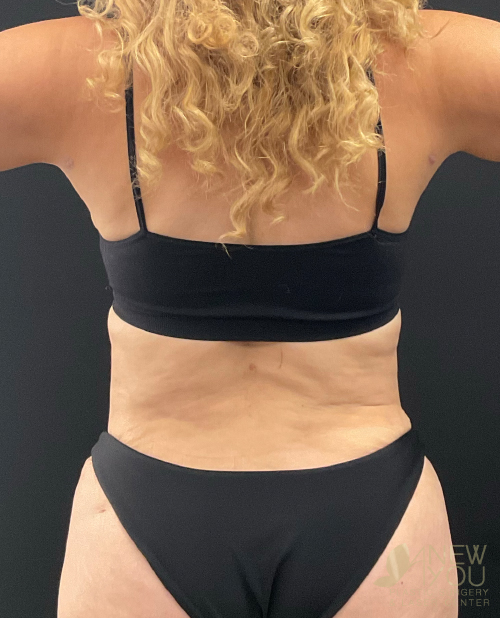 Liposuction After Liposuction After - Chicago, IL