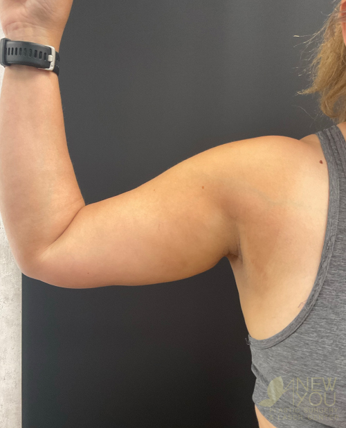 Liposuction Before Liposuction Before - Chicago, IL