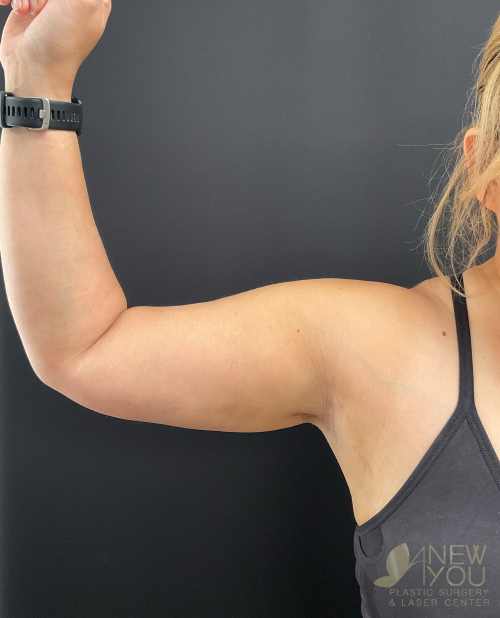 Liposuction After Liposuction After - Chicago, IL