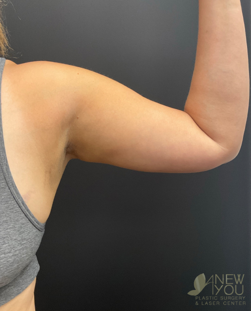 Liposuction Before Liposuction Before - Chicago, IL