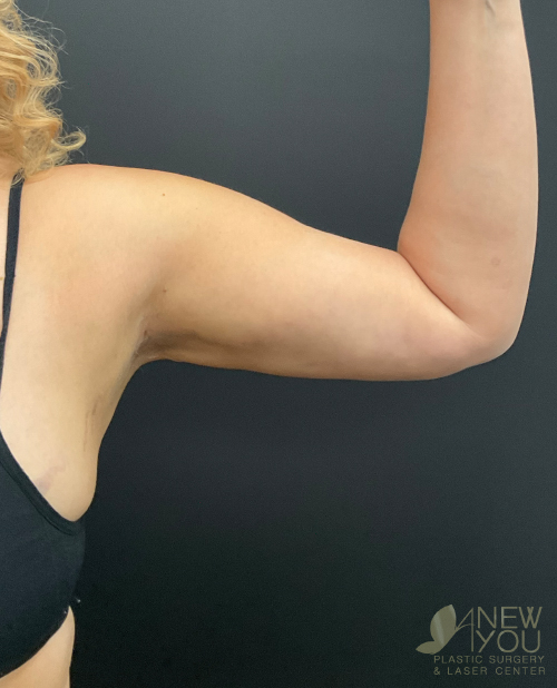 Liposuction After Liposuction After - Chicago, IL