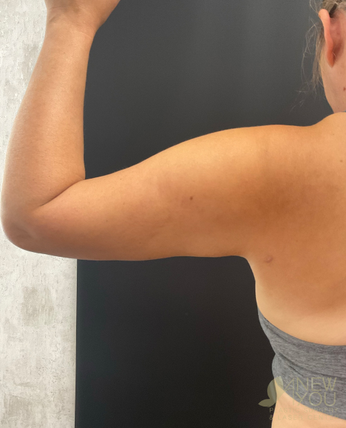 Liposuction Before Liposuction Before - Chicago, IL