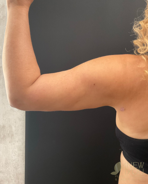 Liposuction After Liposuction After - Chicago, IL