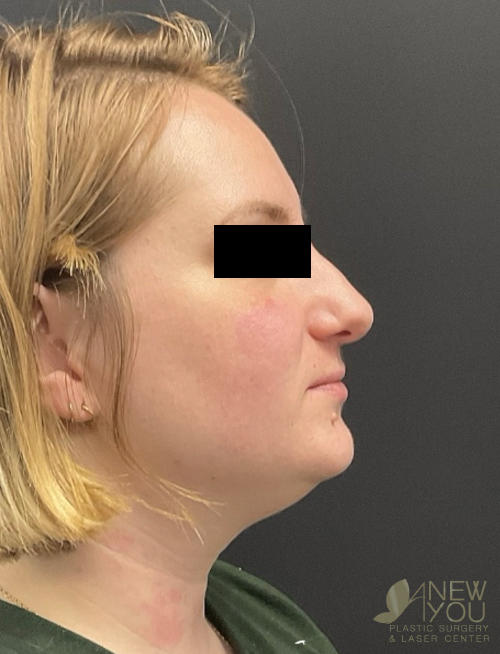 Liposuction Before Liposuction Before - Chicago, IL
