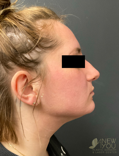 Liposuction After Liposuction After - Chicago, IL
