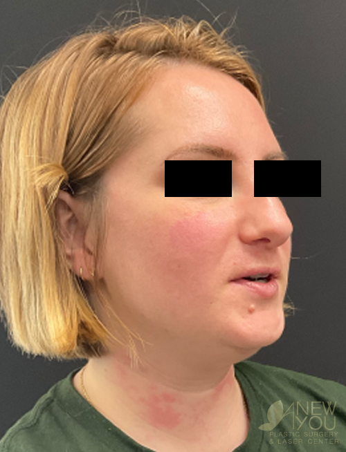Liposuction Before Liposuction Before - Chicago, IL