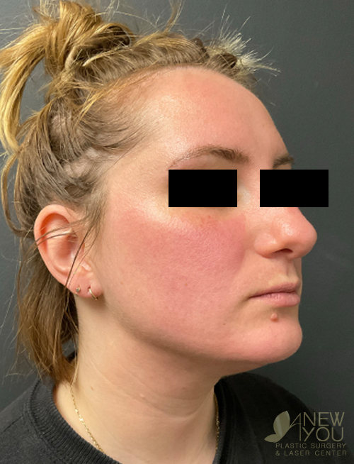 Liposuction After Liposuction After - Chicago, IL